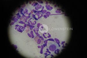 Abb. 4: Eosinophile im zytologischen Präparat