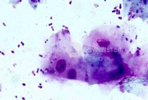 Abb. 4: zytologische Untersuchung: bakterielle Infektion