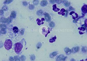 Abb. 5: zytologische Untersuchung: Hefepilz-Sekundärinfektion