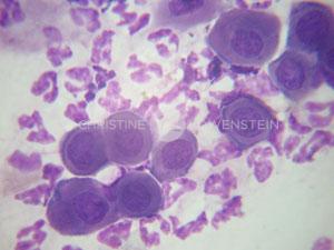 Abb.5: akantholytische Zellen in der zytologischen Untersuchung